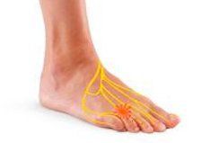 Illustrating areas of neuroma