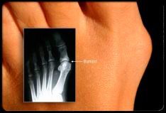 Foot and x-ray showing bunion
