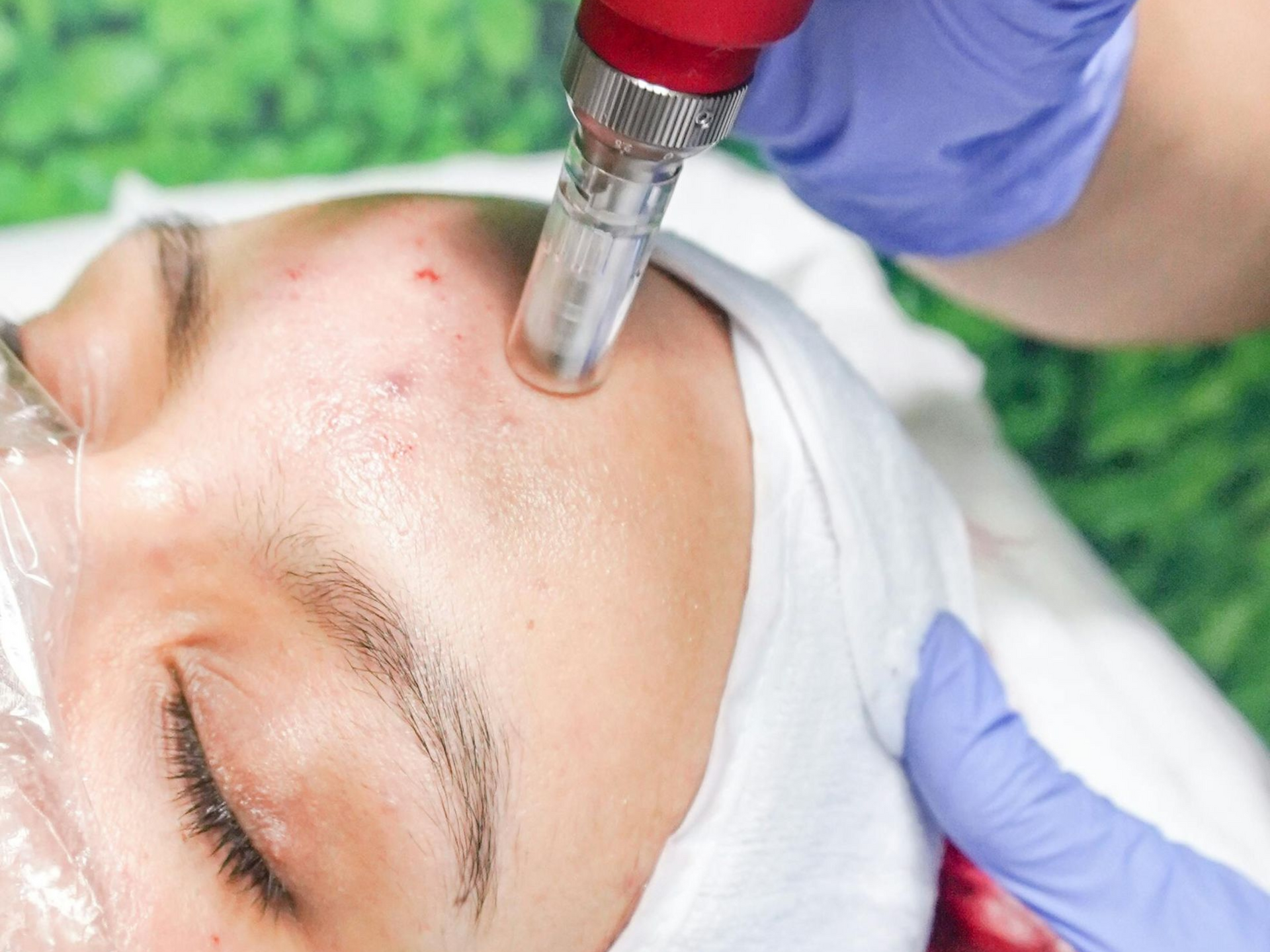 Microneedling image