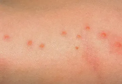 Boutons caractéristiques d'une punaise de lit en gros plan pour identification