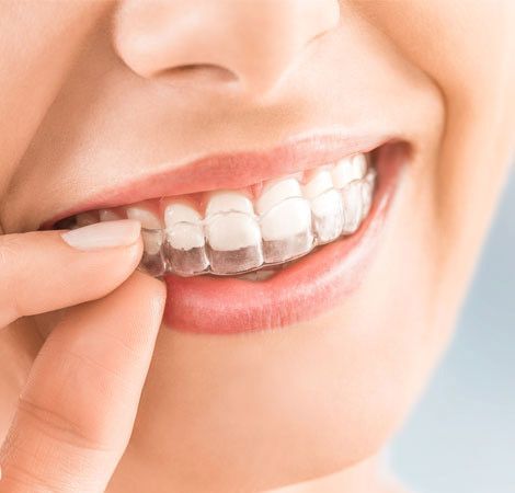 A close up of a woman 's mouth with clear braces on her teeth.