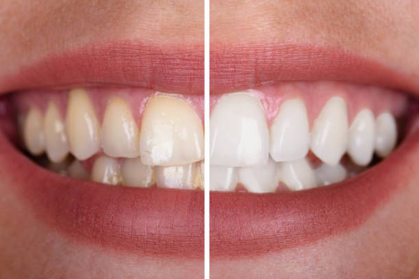 A before and after picture of a woman 's whitened teeth.