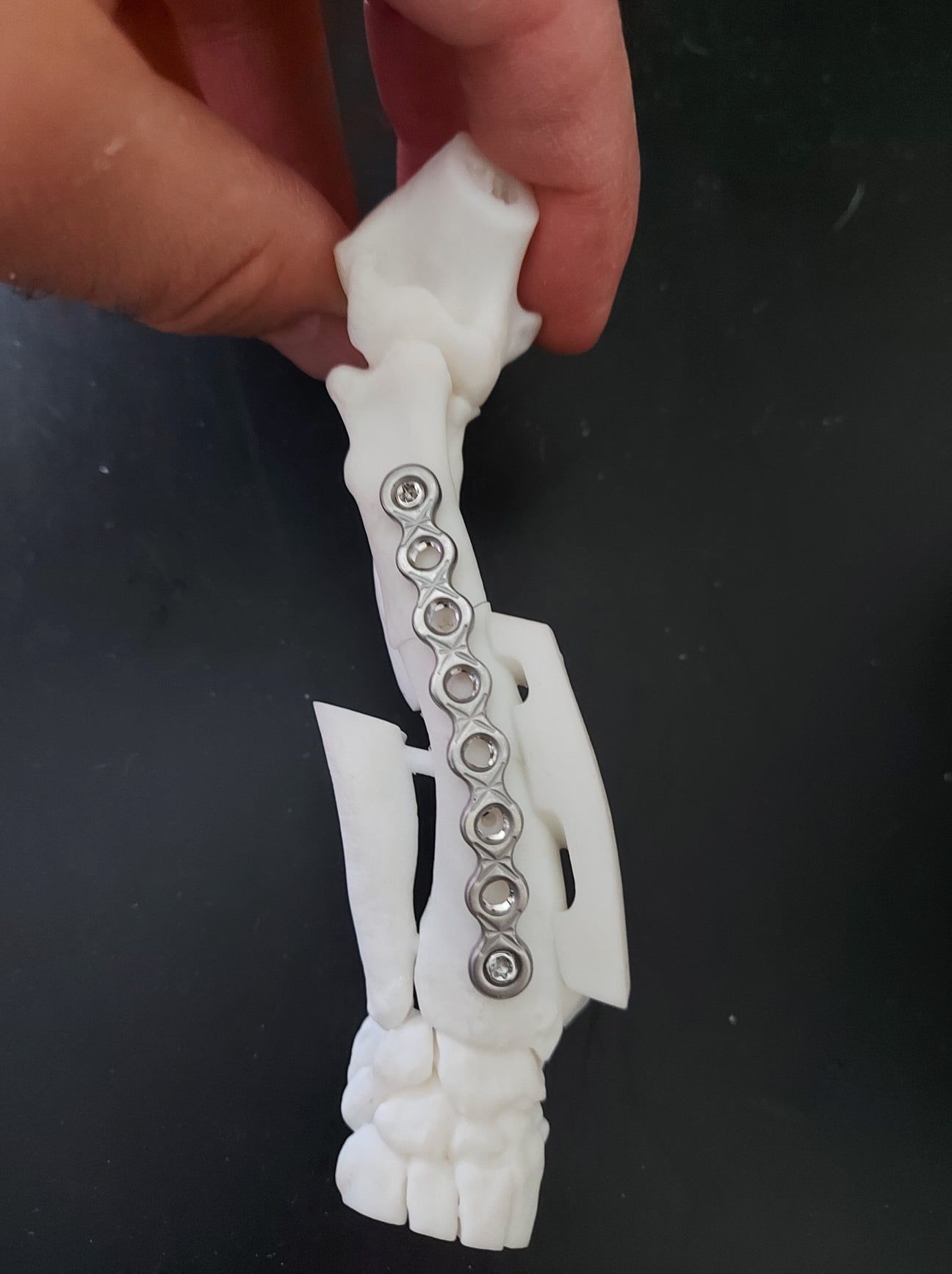 3D Model - Angular Limb Growth Deformity 3D Model - Angular Limb Growth Deformity