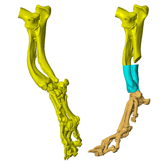 3D Computer Imaging - Angular Limb Growth Deformity 3D Computer Imaging - Angular Limb Growth Deformity