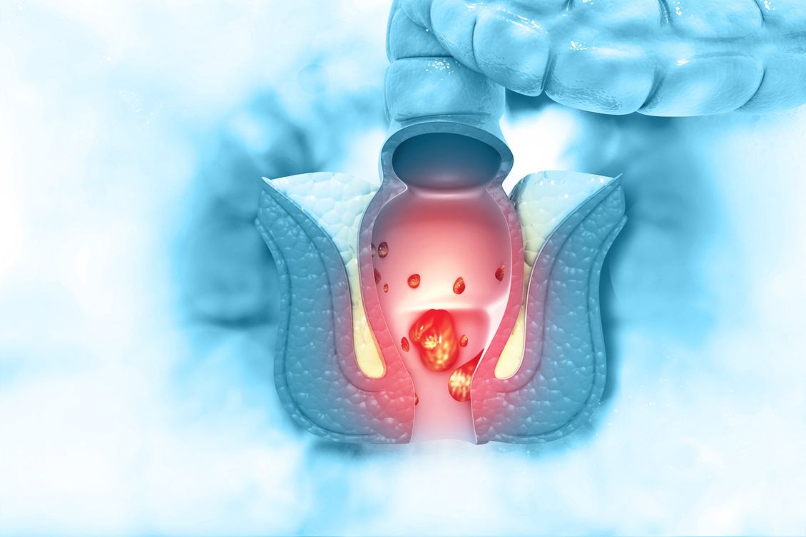 proctologos monterrey imagen colon