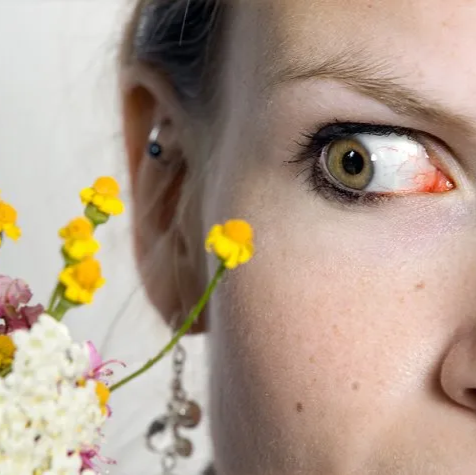 Woman with a red irritated eye looking at a arrangement of flowers Woman with red irritated eye looking at flower arrangement