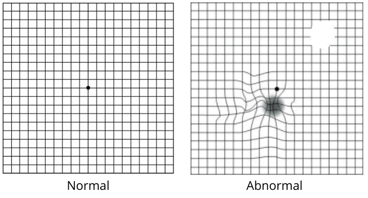 Black and white image of an Amsler Grid for Age related Macular Degeneration