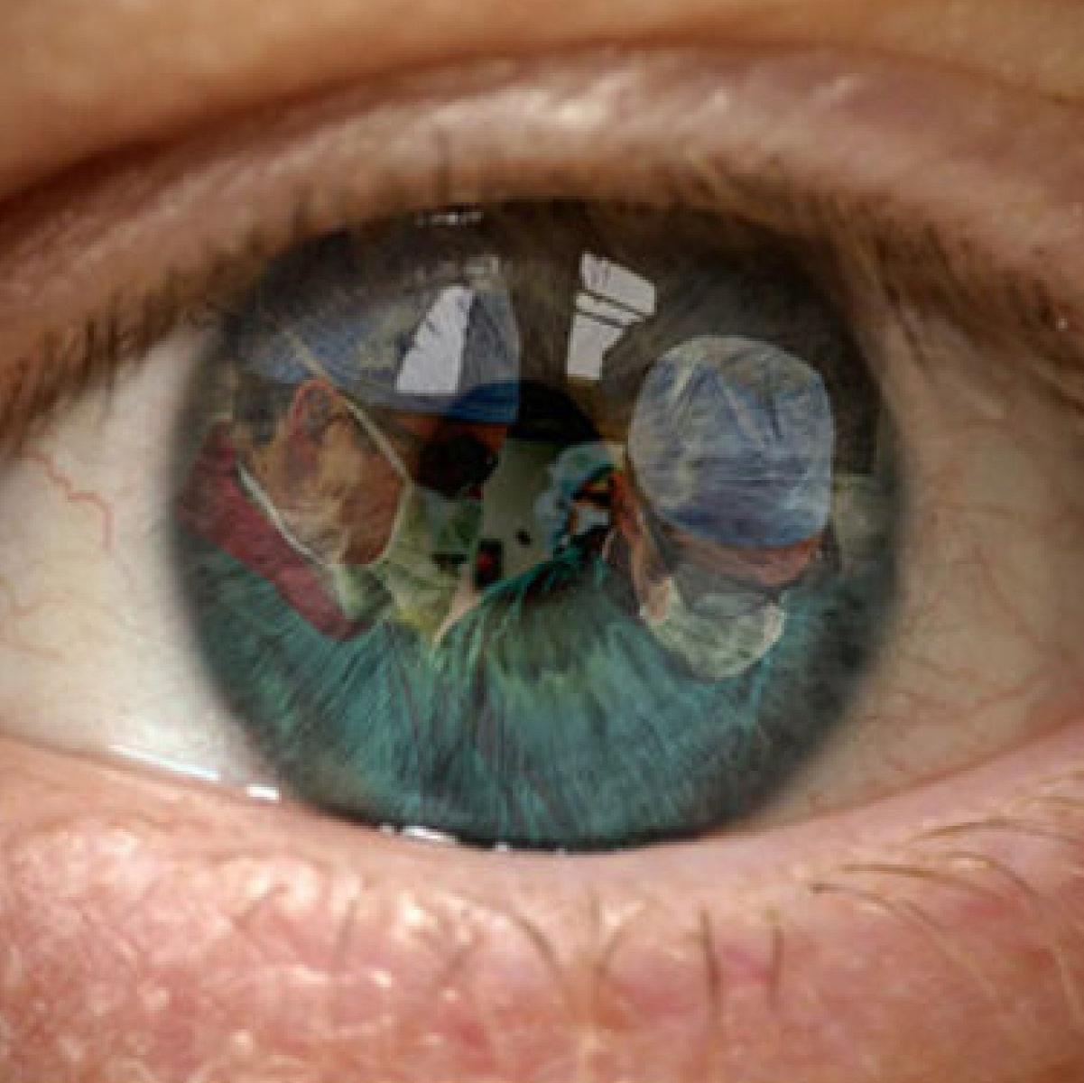 Eye exhibiting signs of cataracts