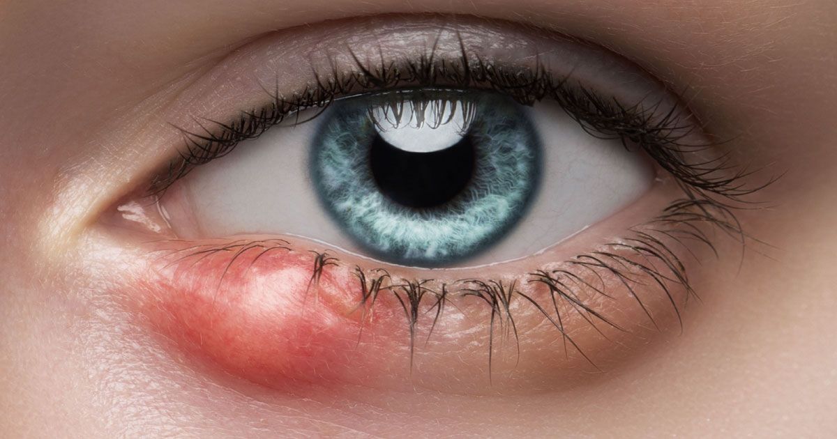 A close up of a woman 's eye with a red swollen bump on her lower eyelid.