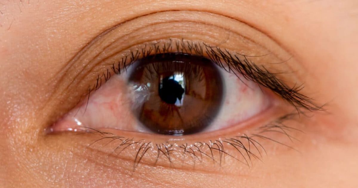 Close-up of an eye with as white fleshy substance in the left corner of the eye.