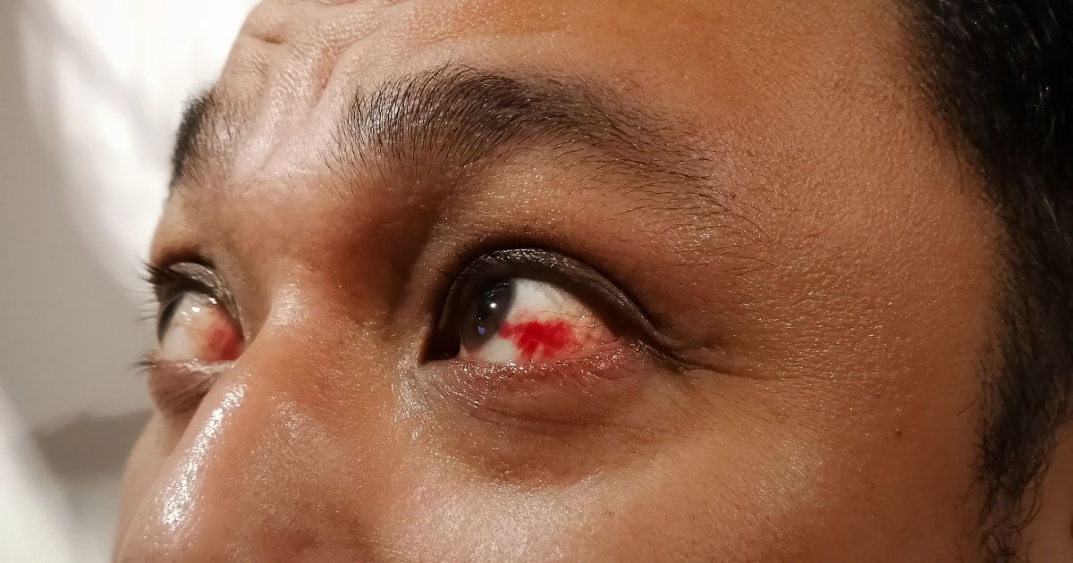 A close up of a man 's eye with a red spot on it.