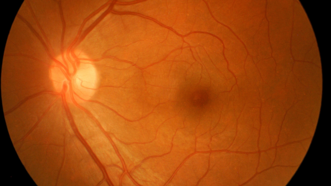 Detailed medical photo of the retina