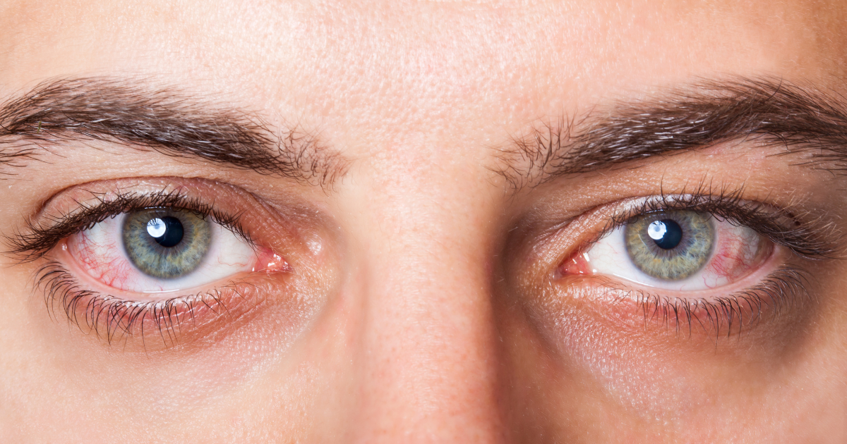 Person with bloodshot eyes