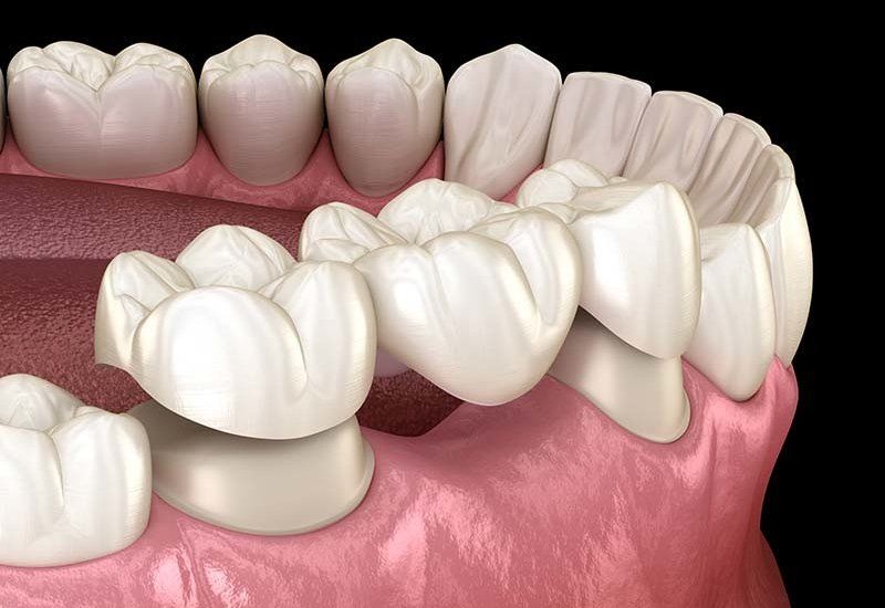 Dental Crowns and Bridges Dental Crowns and Bridges