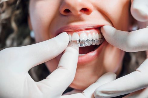 Mani che posizionano gli allineatori trasparenti sui denti. Persona sorridente in primo piano, che indossa gli allineatori.