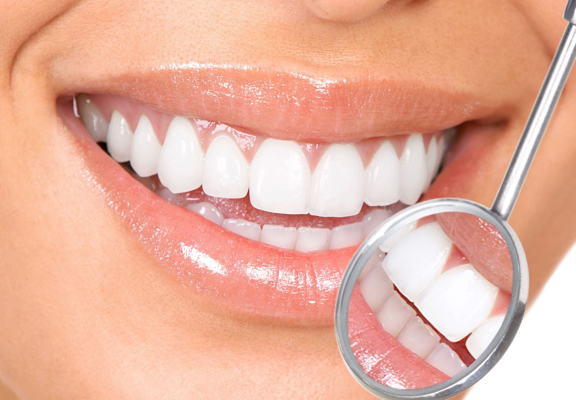 sbiancamento dentale