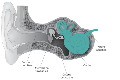 ipoacusia neurosensoriale