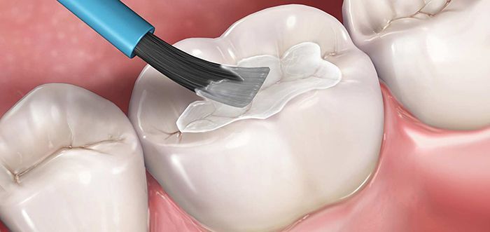 Dental Sealants | Root canals, cleaning, fix gum disease, grinding and more | Best dentist Duke Street Alexandria VA