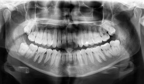 Dental X-Rays | Root canals, cleaning, fix gum disease, grinding and more | Best dentist Duke Street Alexandria VA