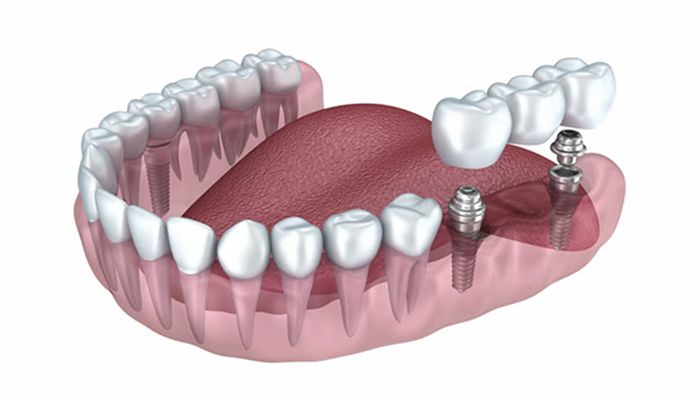Dental Implants example | Best family dentist in Alexandria VA