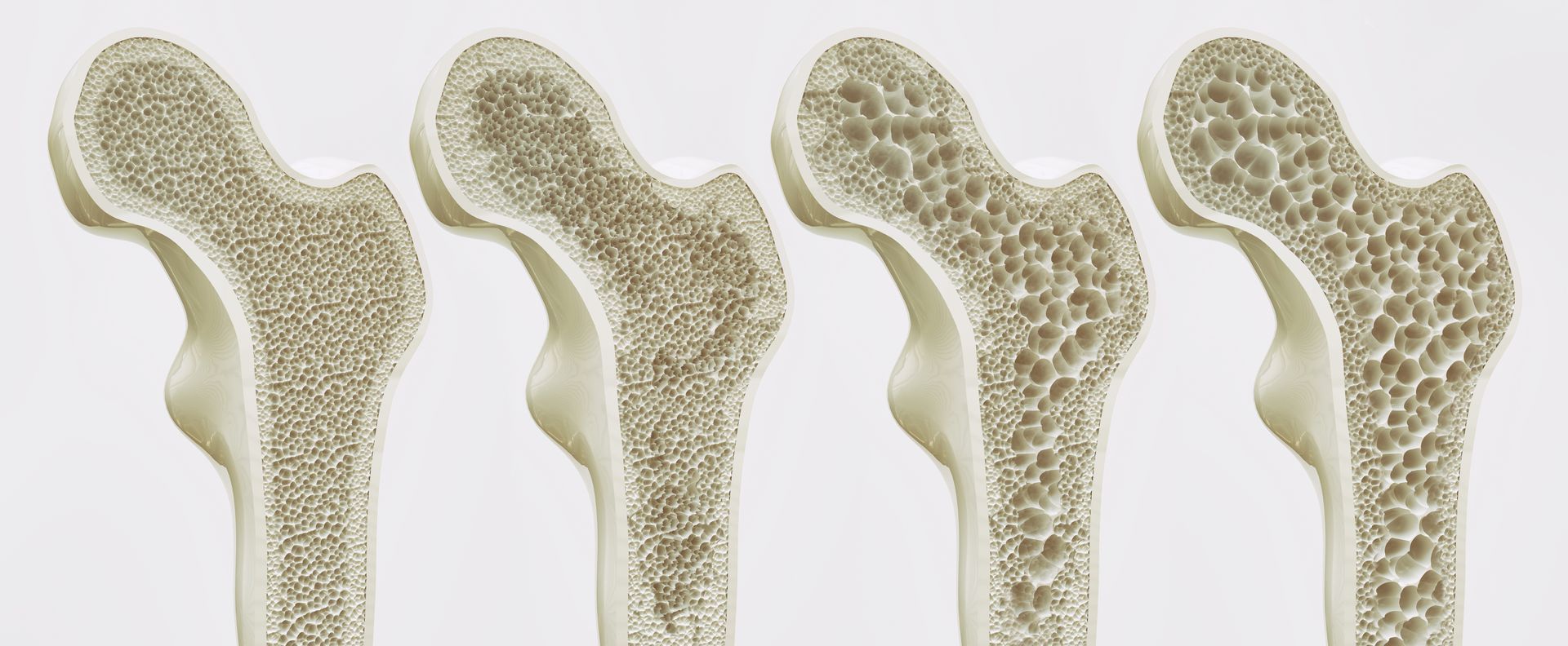 Osteoarthritis — Inner Balance Health in Coconut Grove, NT