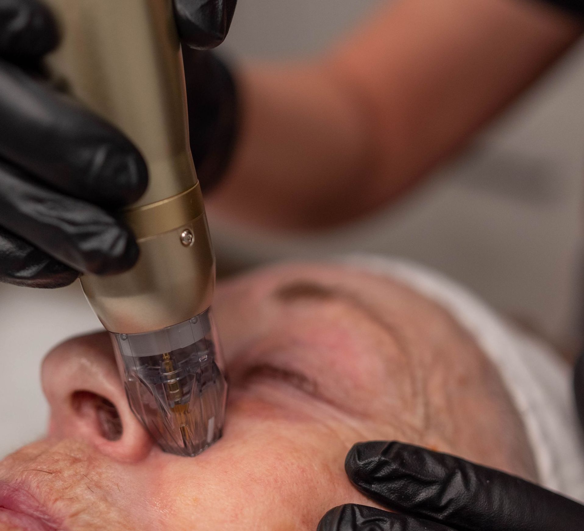 A gloved esthetician using a facial treatment device on a client’s nose and cheek.