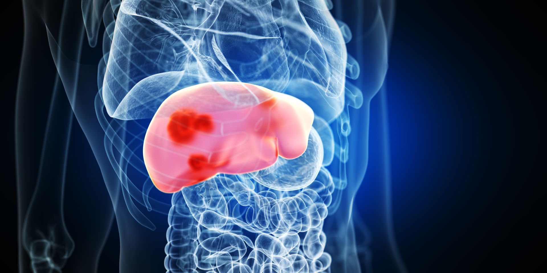A computer generated image of a liver with cancer.