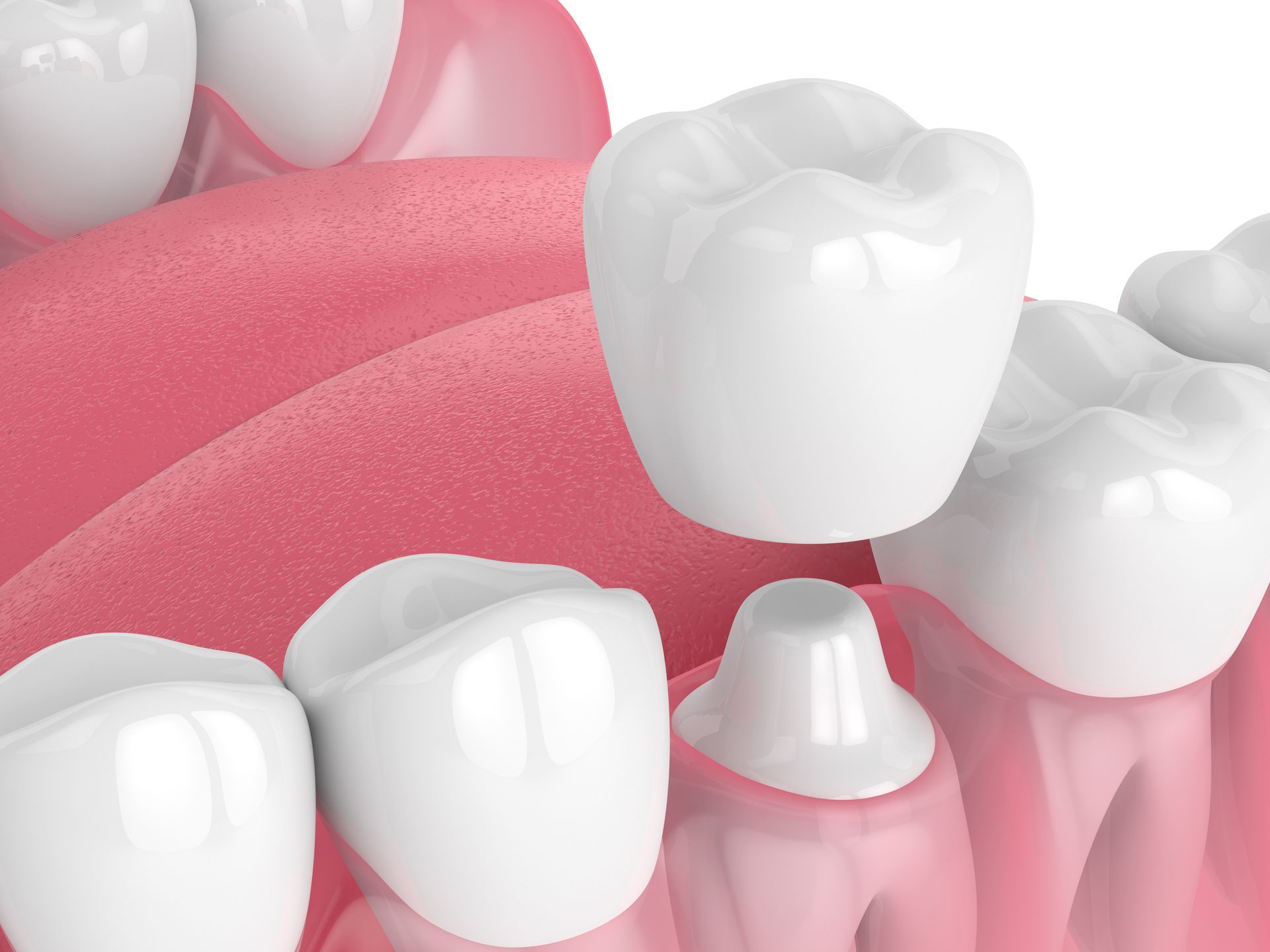 Illustration of dental implants and crowns in pink gums, showing a replaced missing tooth.
