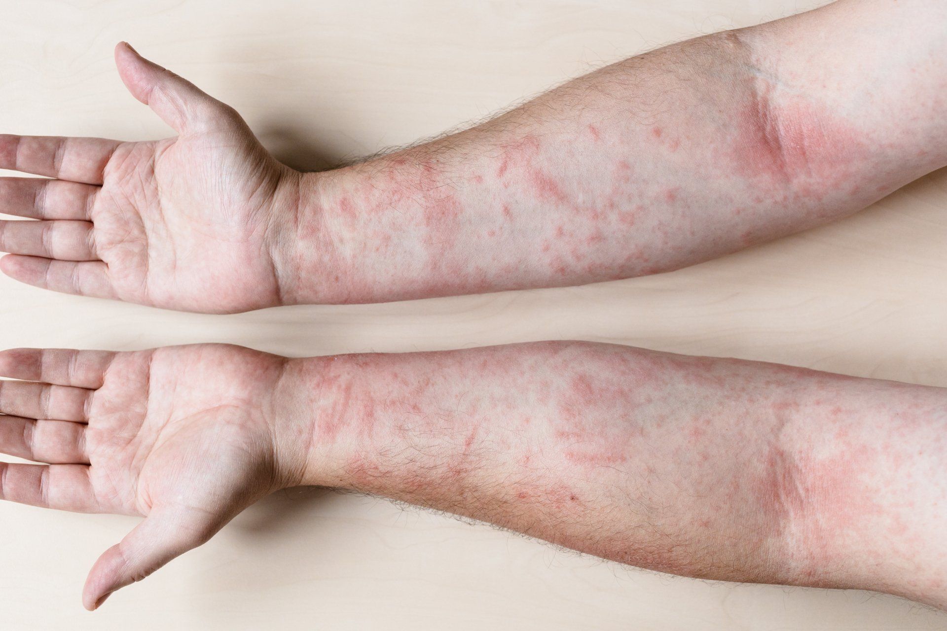 Two forearms with red, patchy rash on pale skin, palms up on a white background