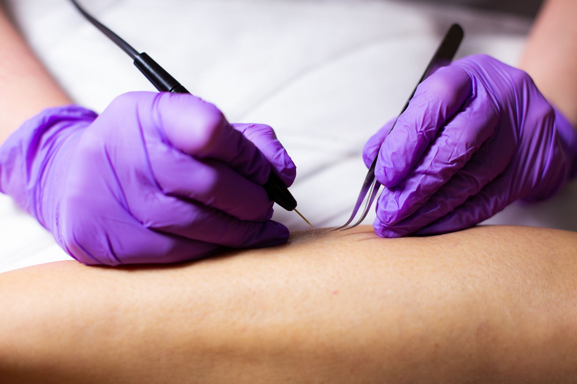 Purple-gloved hands using medical tools on a patient’s skin during a procedure