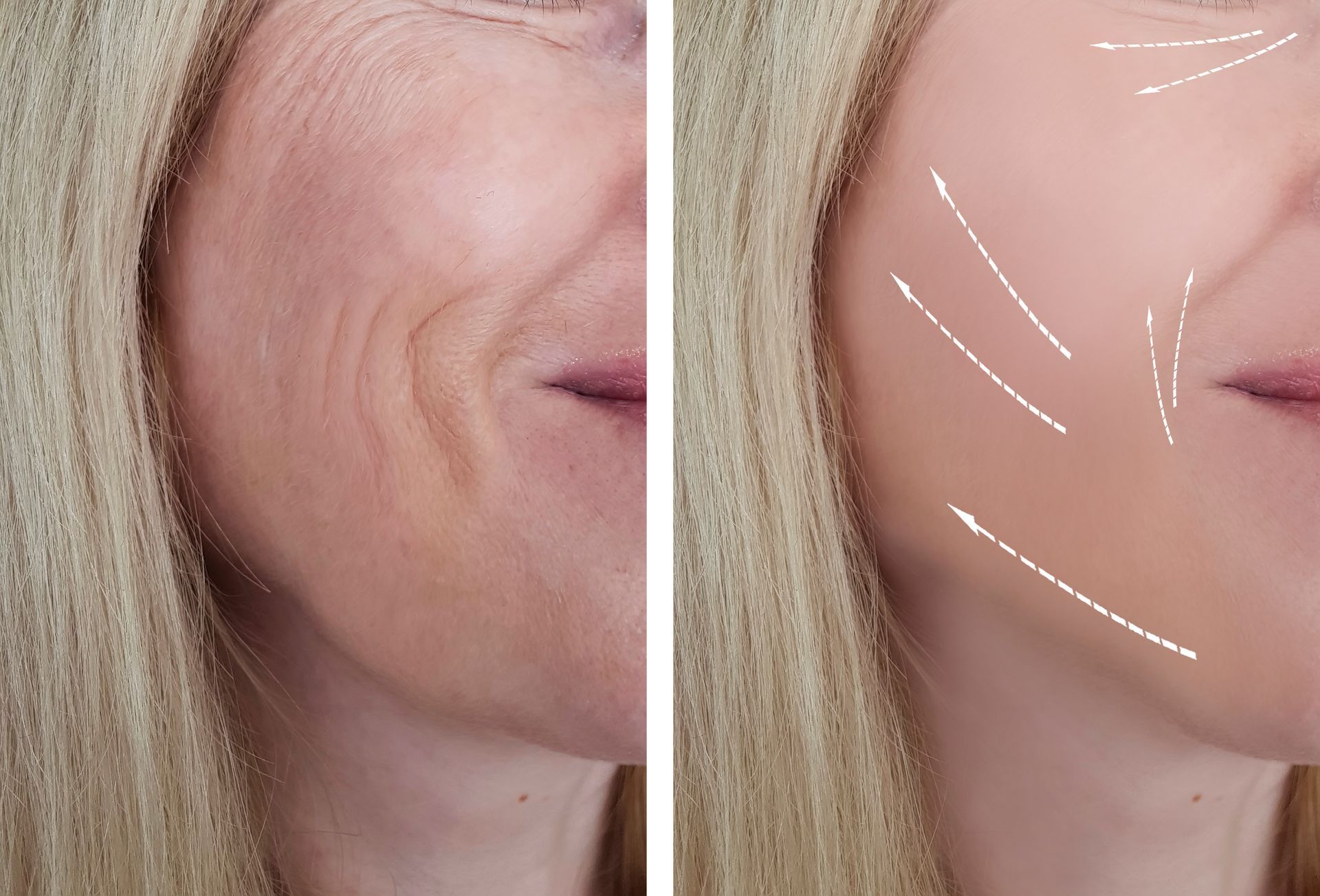A before and after picture of a woman 's lips with arrows pointing in different directions. A before and after picture of a woman 's lips with arrows pointing in different directions.