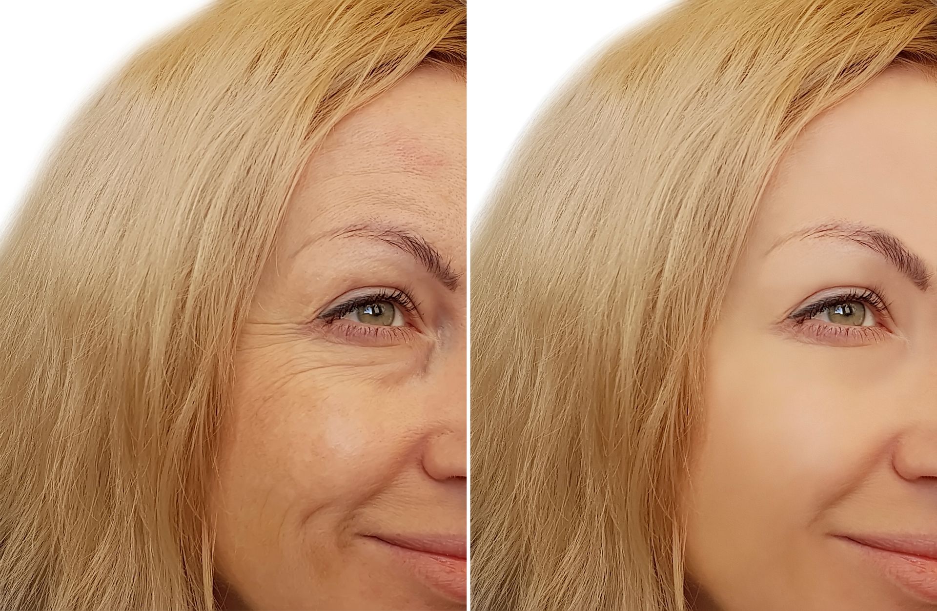A man with a beard is getting a botox injection in his face. A man with a beard is getting a botox injection in his face.