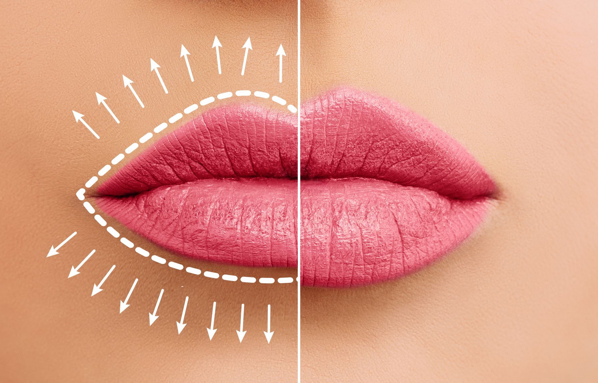 A before and after picture of a woman 's lips with arrows pointing in different directions. A before and after picture of a woman 's lips with arrows pointing in different directions.