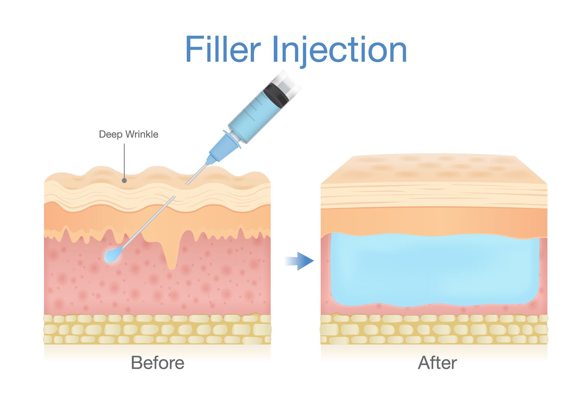 A before and after picture of a filler injection in the skin. A before and after picture of a filler injection in the skin.