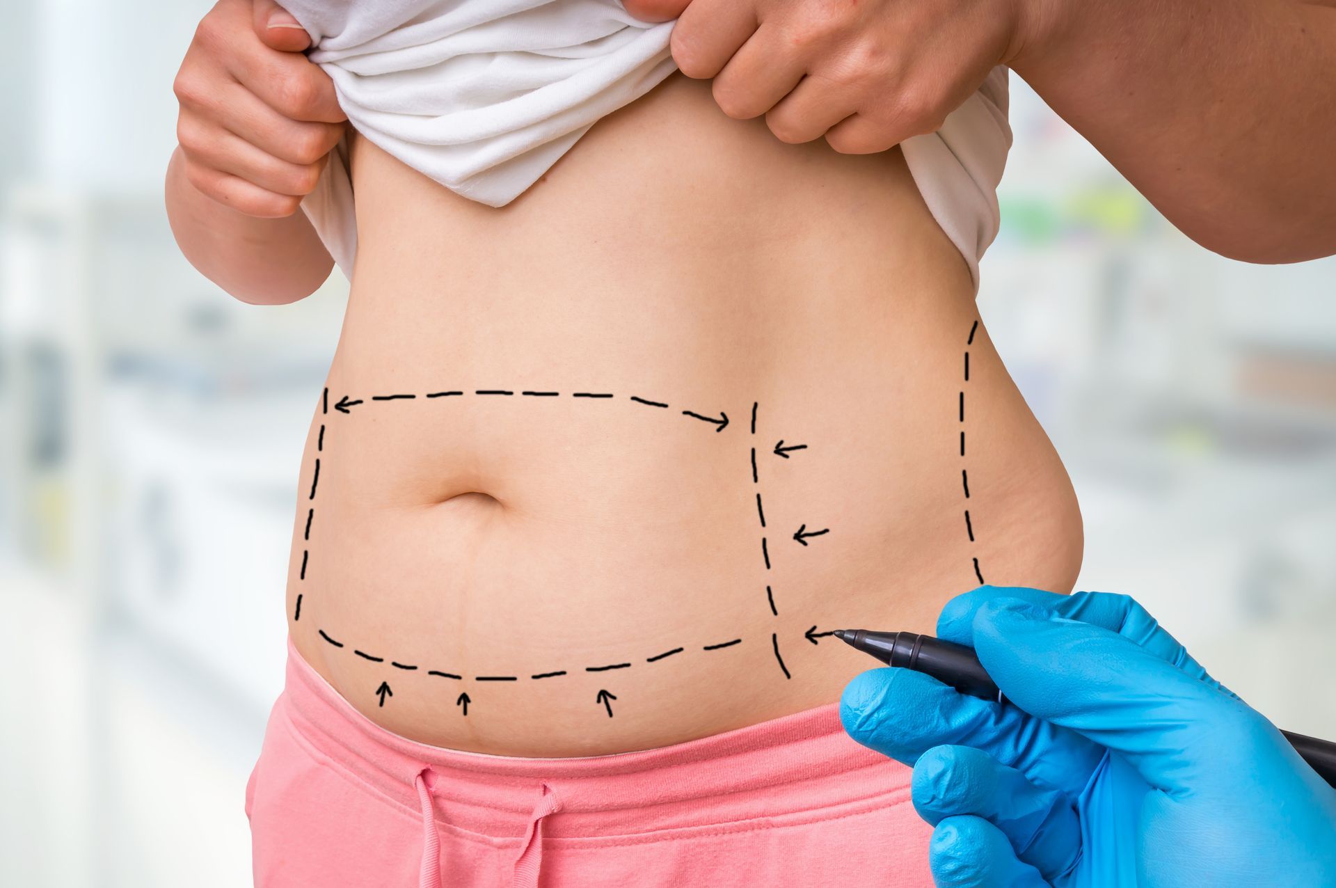 Marked abdomen with measurement arrows while a gloved hand points, suggesting cosmetic surgery planning