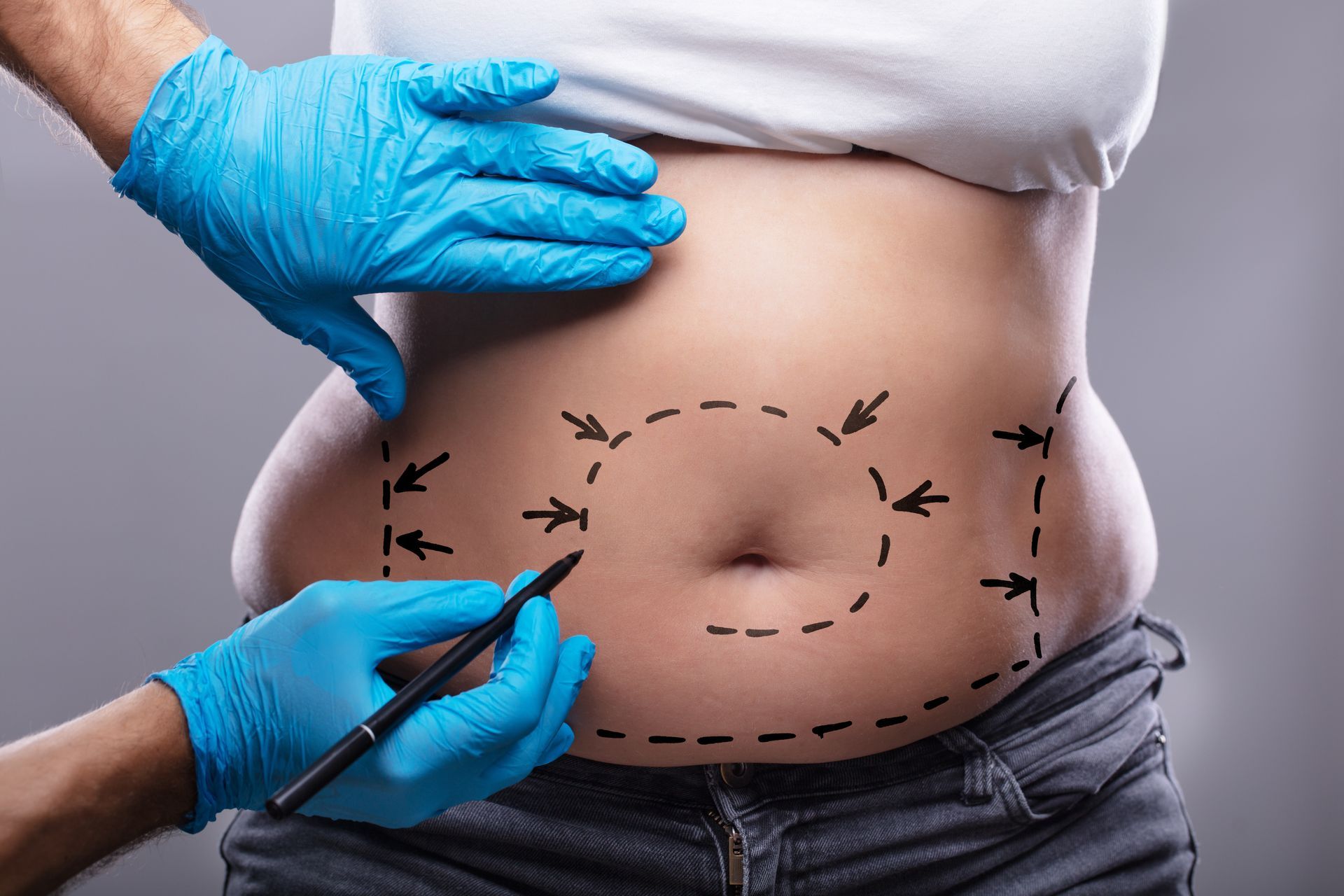 Gloved hands marking a belly with a measuring tape and dotted outline for body contouring or weight loss planning