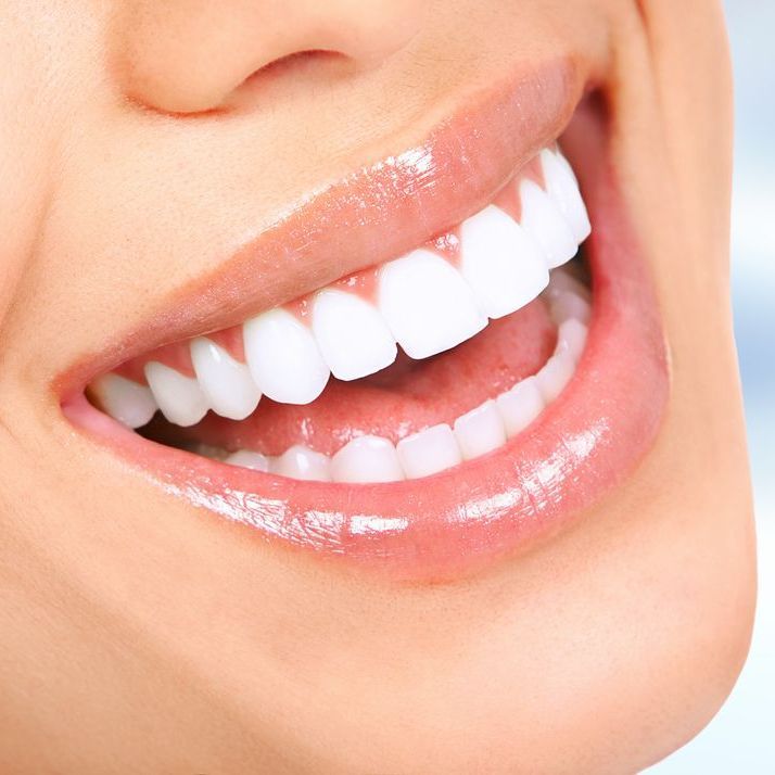 man with teeth colored veneers