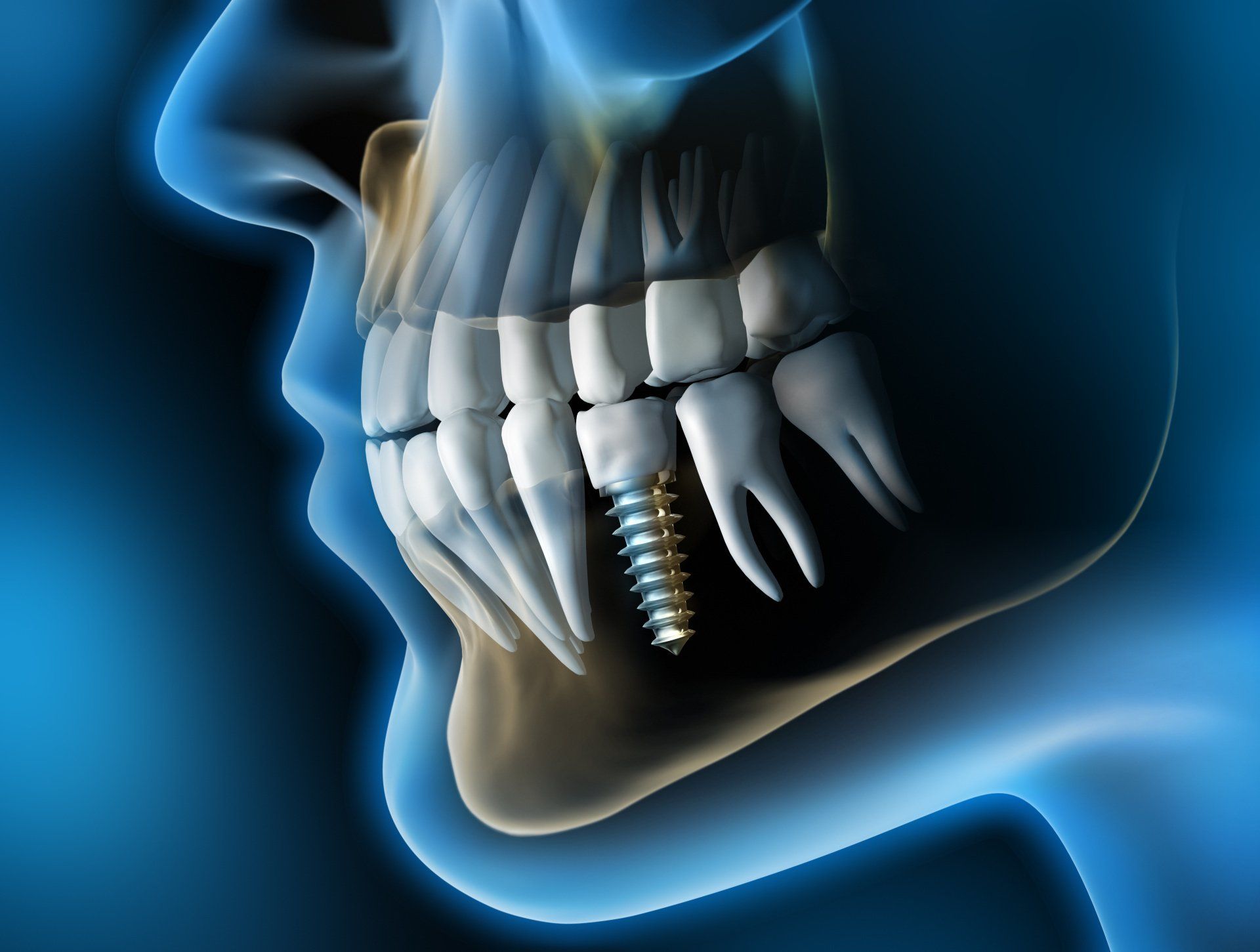 dentista Naldini Livorno implantologia