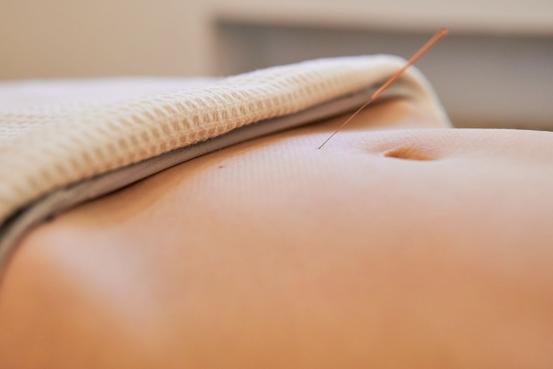 A person is getting acupuncture on their stomach.