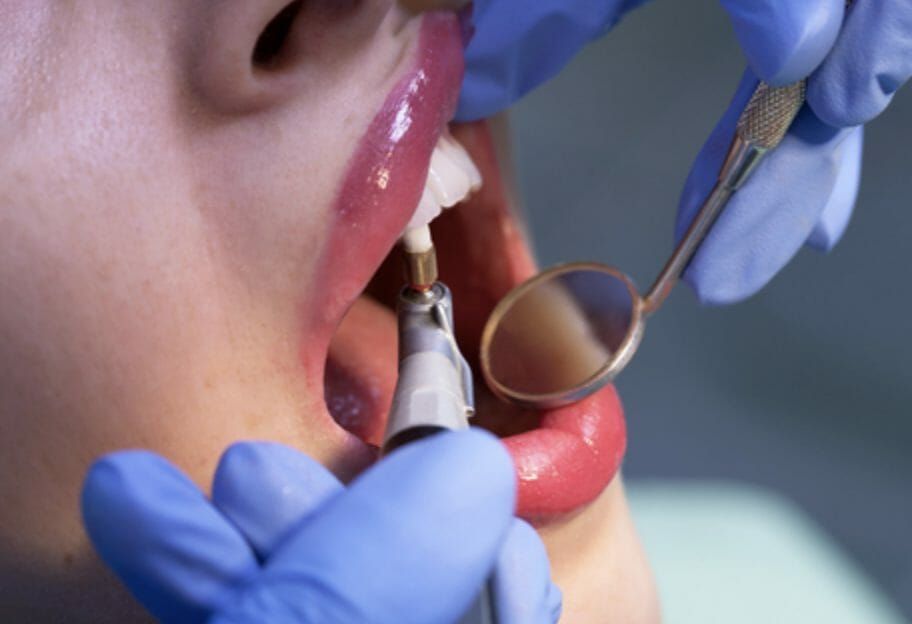 Dentist drilling a patient’s tooth with mirror and gloved hands in a clinical setting