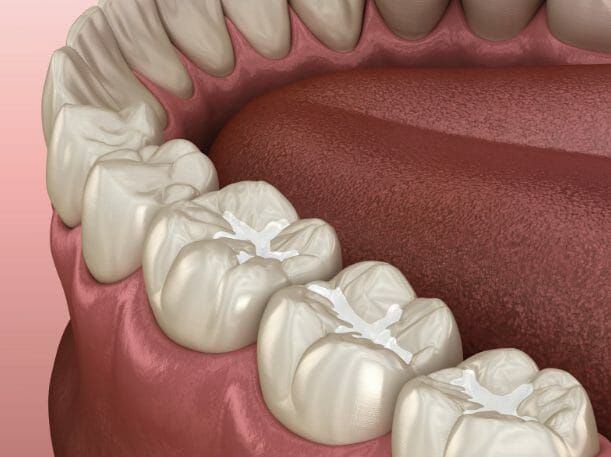 Close-up of molars with white dental fillings on a pink gums background