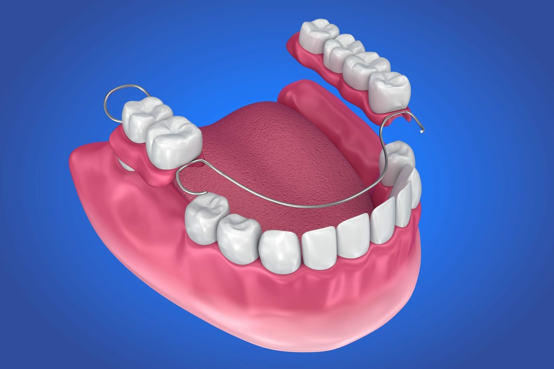 3D dental model of lower jaw with red gums, white teeth, and two highlighted braces wires