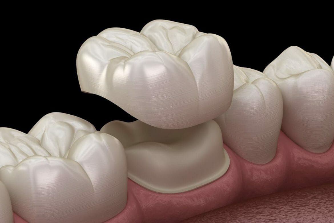 Close-up 3D rendering of a dental crown on a tooth next to natural teeth and pink gums