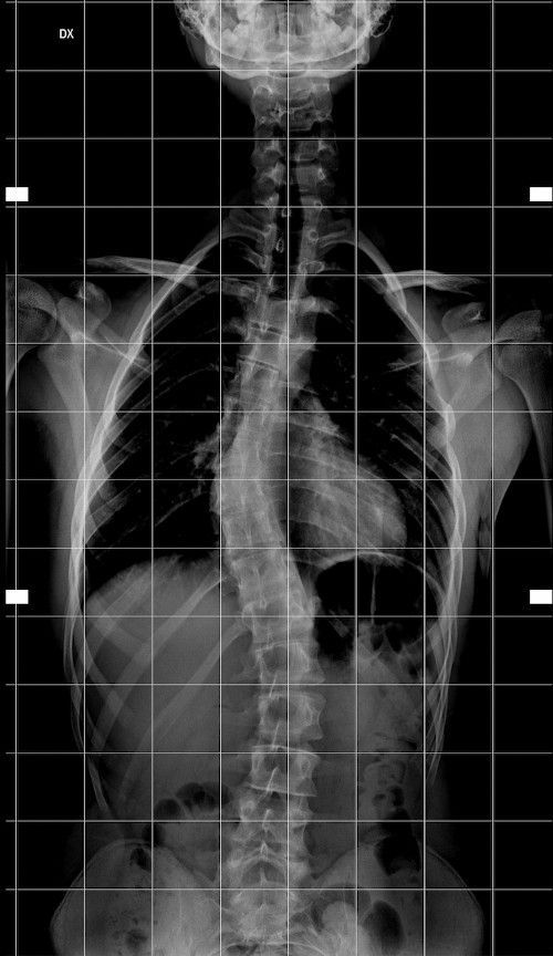L'ozonoterapia è un potente virucida