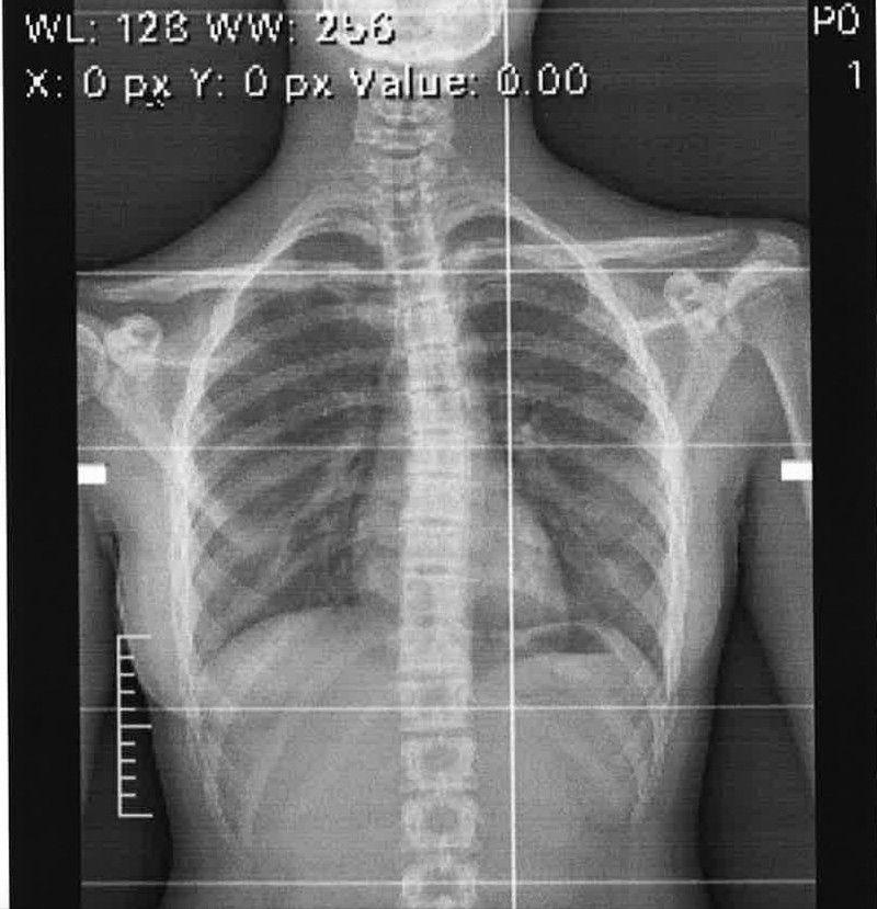 L'ozonoterapia è un potente virucida