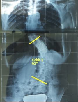 L'ozonoterapia è un potente virucida
