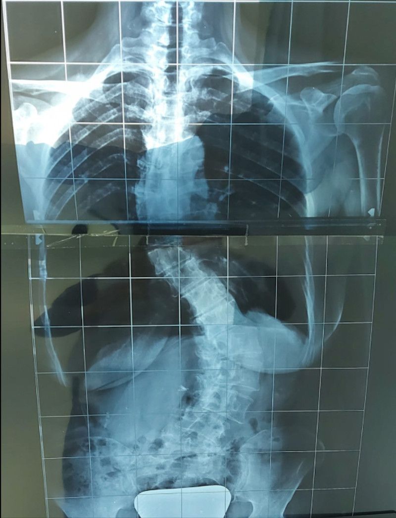 L'ozonoterapia è un potente virucida