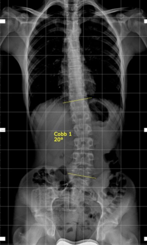 L'ozonoterapia è un potente virucida