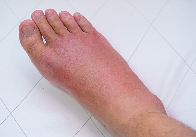 L'ozonoterapia è un potente virucida