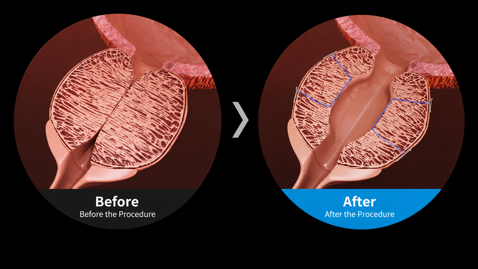 Progator suture-ligation steps opening the prostatic urethra — Urogyn Busan